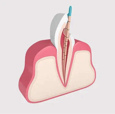 Advancements-in-Root-Canal-Therapy-What-Patients-Must-Know