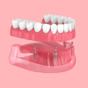 Fed-Up-with-Dentures-Slipping-Discover-the-Benefits-of-All-on-4-Implants