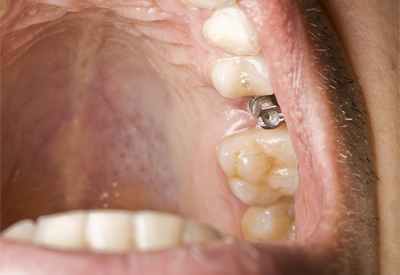 dental implant with cover screw showing